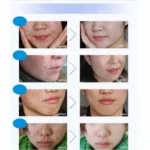 Benefits of Bioaqua acne relief cream for reducing acne breakouts and pimple marks